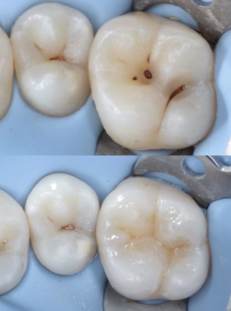 Close-up comparison of molars before and after dental sealants in Brampton