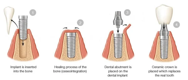 dental-implants-process