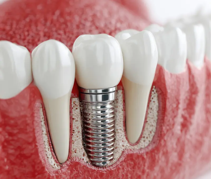 dental-implants-brampton