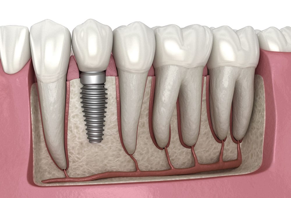 dental-implants-treatment