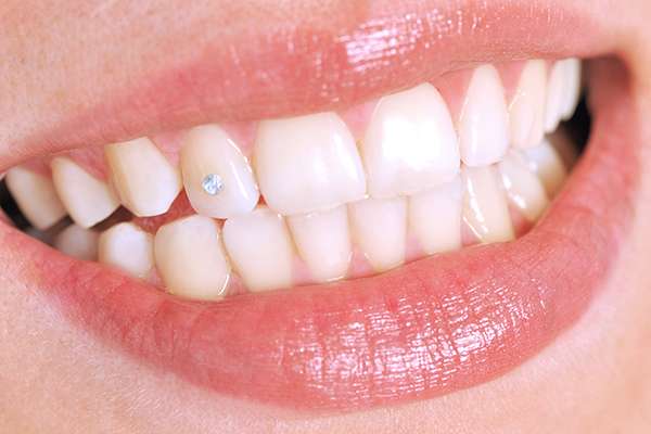 Diamond Tooth Gems Brampton – close-up of a gem attached to a front tooth