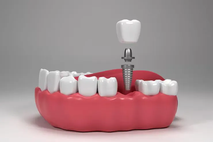 Dental implant replacing the root of a missing tooth