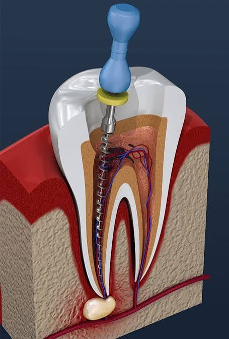Diagram showing a dental implant within the jaw