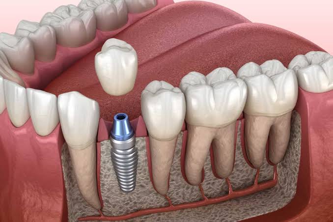 Dental implant crown positioned above an implant post in a jaw illustration