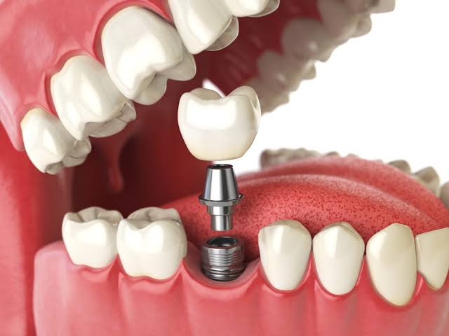 Illustration showing how a single tooth implant can replace one missing tooth