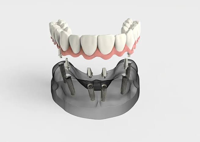 All-on-X dental implants supporting a full-arch prosthesis