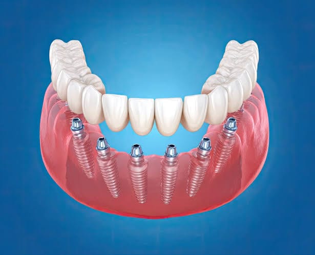 All-on-X dental implants supporting a full-arch restoration